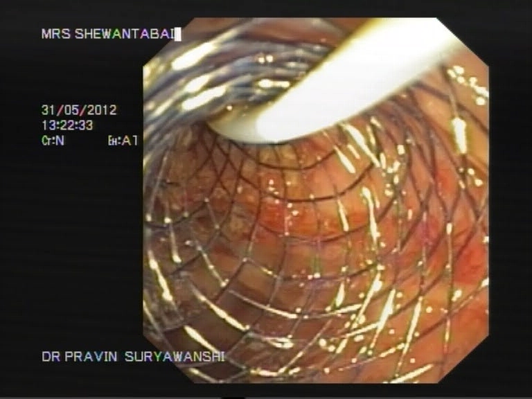 Endoscopy in Aurngabad | Dr. Pravin Suryawanshi