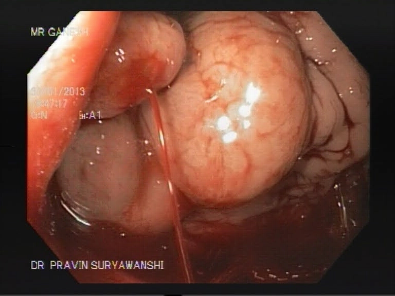 Open General Surgery - Dr. Pravin Suryawanshi